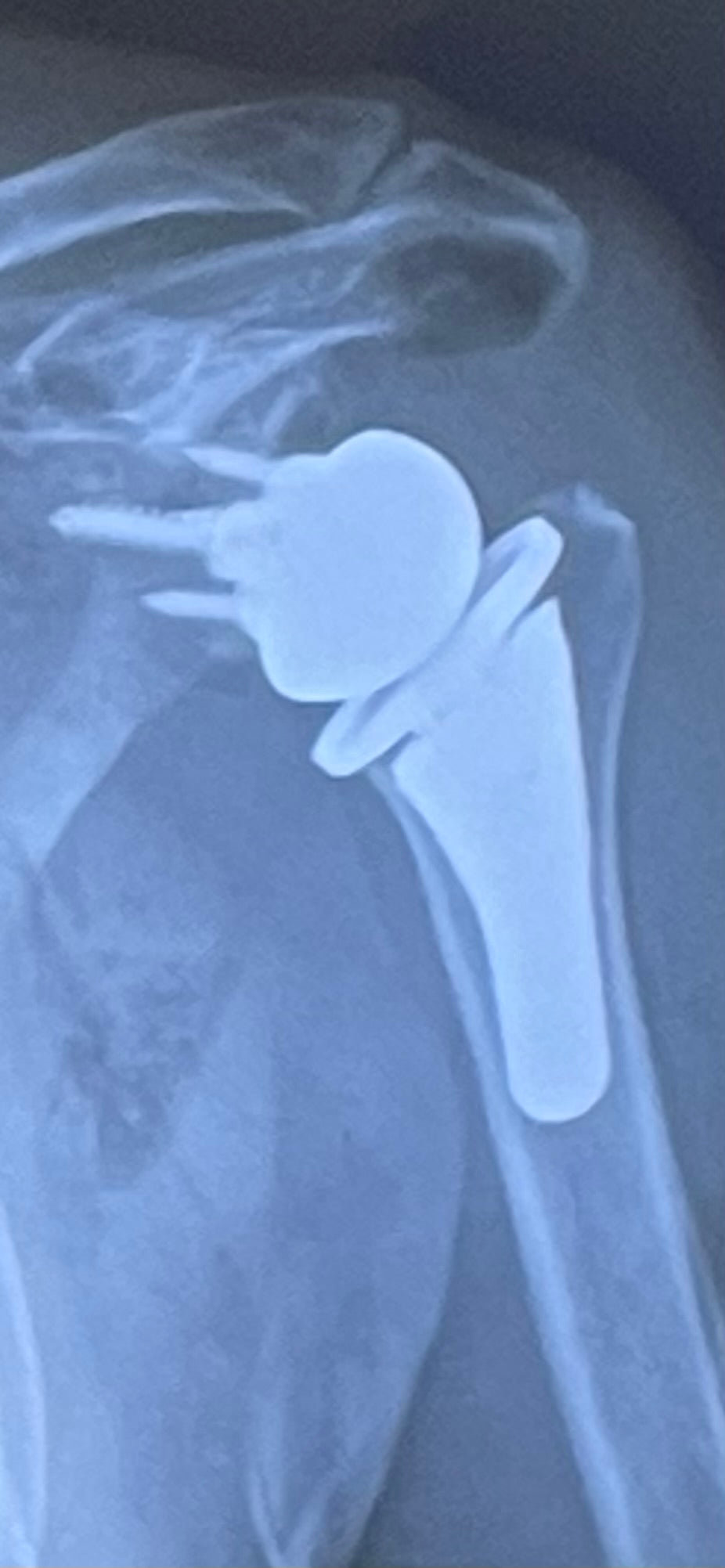 Shoulder Replacement Surgery